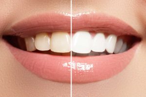 Teeth whitening in Anderson from Dr. Jay Elbrecht