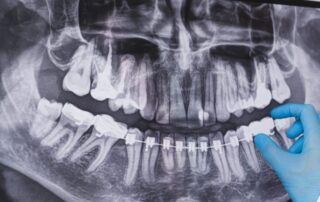 Doctor points to braces in dental x-ray